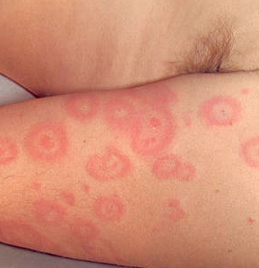 Herpes Simplex - Dermatology Consultants - Skin Secrets