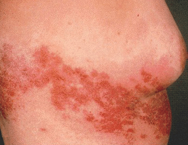 Viral Rashes. Rashes and Itchy Skin. Causes and treatment ...