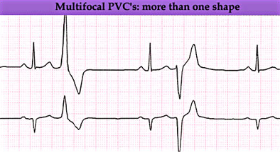 contractions