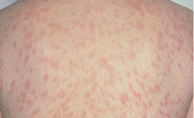 Pityriasis Rosea — Medlibes: Online Medical Library