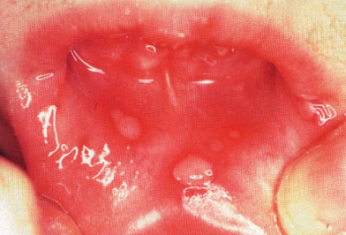 Lesions On Throat 54