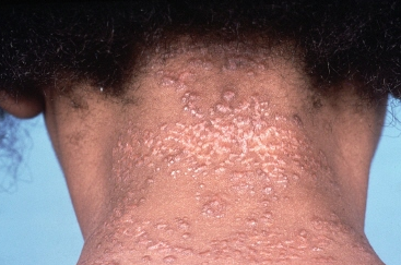Neck rash - RightDiagnosis.com