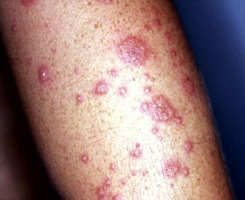 Toxic Epidermal Necrolysis Pictures, Images ... - Photobucket