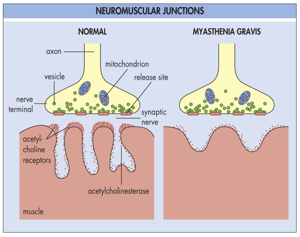 acetylcholine receptor myasthenia gravis