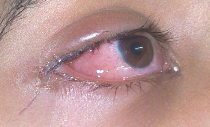 eyelid eczema natural treatment – MedHelp