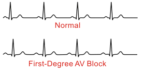 First-degree AV Block — Medlibes: Online Medical Library