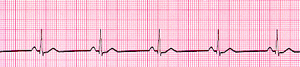 Sinus Bradycardia — Medlibes: Online Medical Library