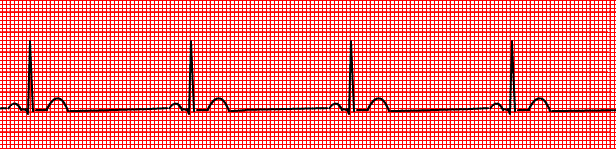 Sinus Bradycardia — Medlibes: Online Medical Library