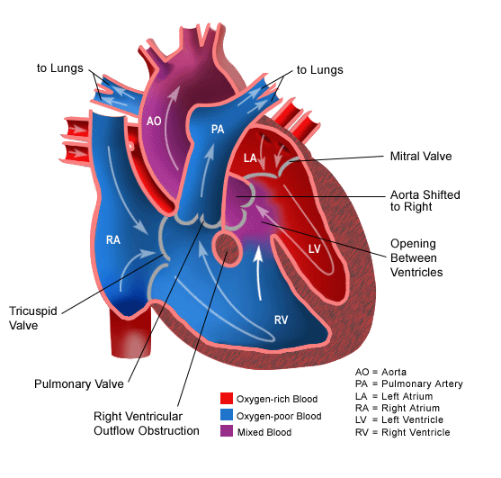 Tetralogy of Fallot — Medlibes: Online Medical Library