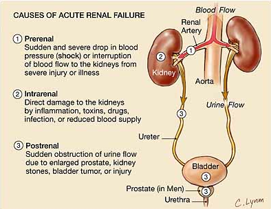 acute renal failure arf