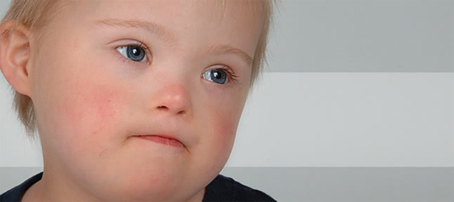 Downs Syndrome Medlibes Online Medical Library